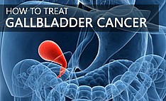 Gallbladder Cancer Treatment 